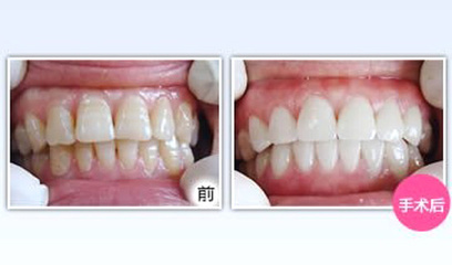 洗牙的過(guò)程是怎樣的