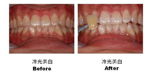 牙齒美白有哪些注意事項