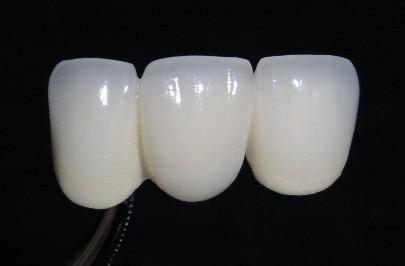 全瓷牙與烤瓷牙的區(qū)別