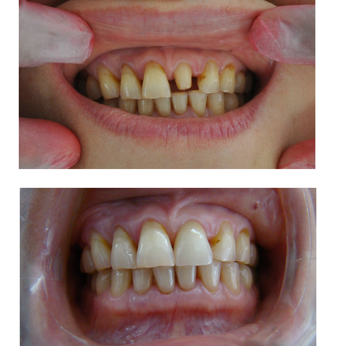 烤瓷牙的價格高嗎