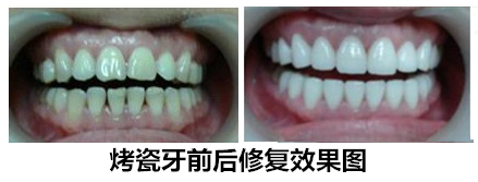 做一顆烤瓷牙需要多少錢