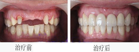 烤瓷牙的費(fèi)用高嗎