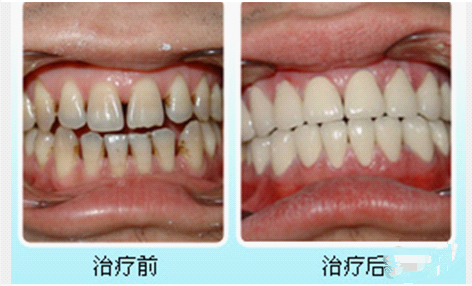 漳州烤瓷牙價(jià)格是多少