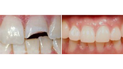 鑲牙有哪些方法