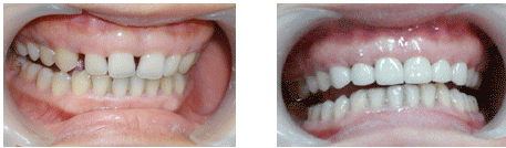 鑲牙的方式有哪些