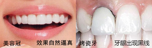 美容冠與傳統(tǒng)烤瓷牙的區(qū)別是什么