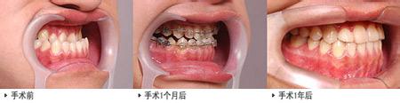 地包天牙齒矯正貴不貴
