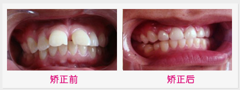 齙牙矯正的過(guò)程是怎樣的
