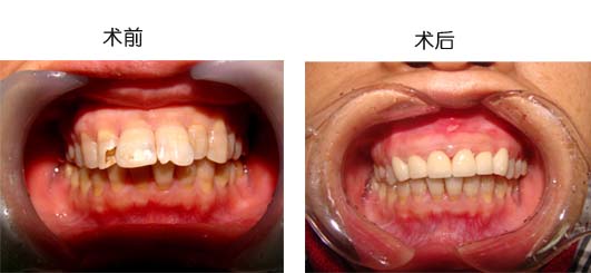 齙牙矯正要多久