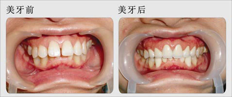 牙齒稀疏矯正需要多少錢