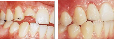 牙齒缺損修復(fù)的價(jià)格是多少
