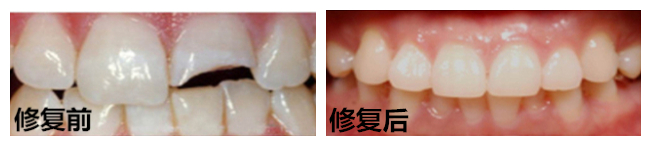 牙齒缺損修復的費用