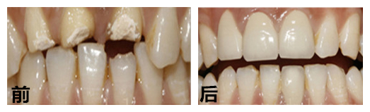 影響牙齒缺損修復(fù)價格的因素有哪些