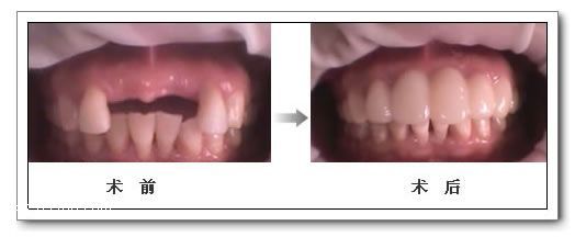 種植牙修復(fù)牙齒缺失的優(yōu)點有哪些