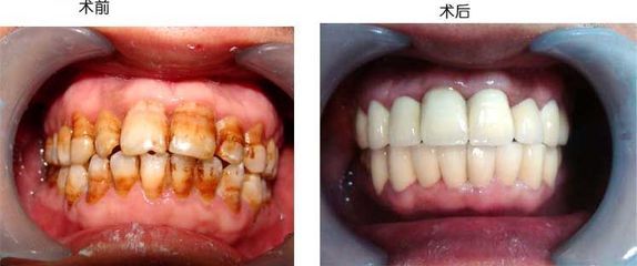煙漬牙的危害有哪些