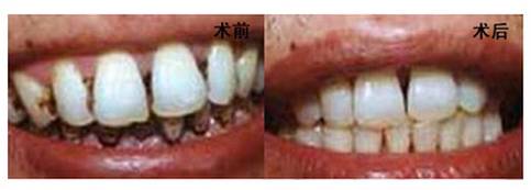 怎么美白煙漬牙