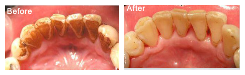 激光美白煙漬牙的過程