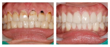 茶漬牙的危害有哪些