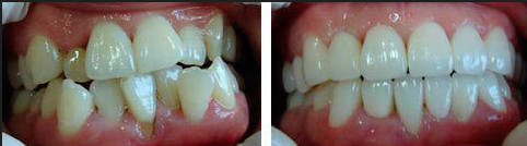牙齒擁擠矯正多少錢