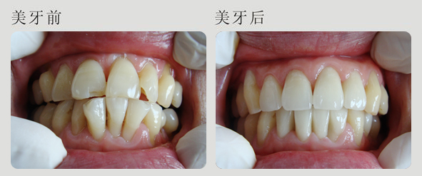 成人牙齒擁擠可以治療嗎