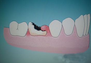 如何做到蛀牙早發(fā)現(xiàn)