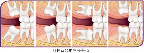 智齒拔除后的注意事項(xiàng)有哪些