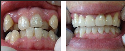 牙齒不齊的危害有哪些呢