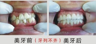 牙齒不齊怎么辦呢