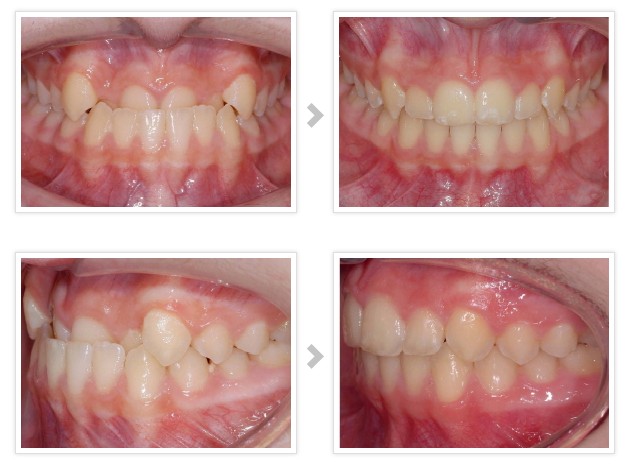 地包天如何矯正
