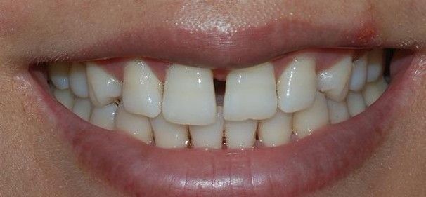 牙間隙過大怎么辦