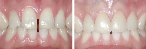 牙間隙矯正的費(fèi)用