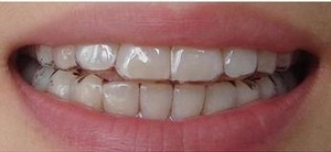 無托槽隱形矯正戴多久