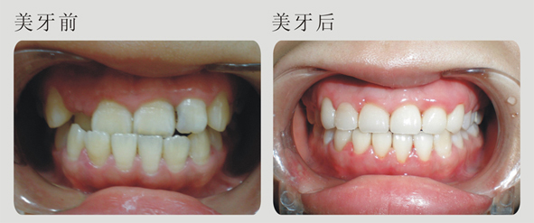 雙頜前突怎么辦