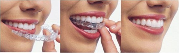 牙齒矯正大概多少錢