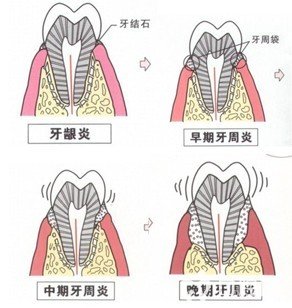 牙周炎的危害有哪些