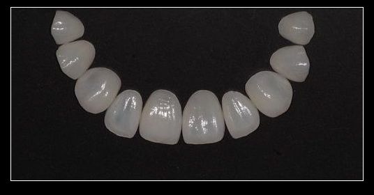 瓷貼面的優(yōu)點