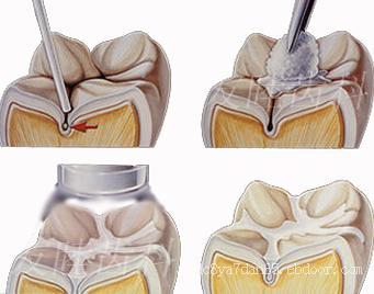 兒童窩溝封閉什么時(shí)候比較合適