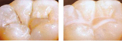 哪些牙齒適合窩溝封閉