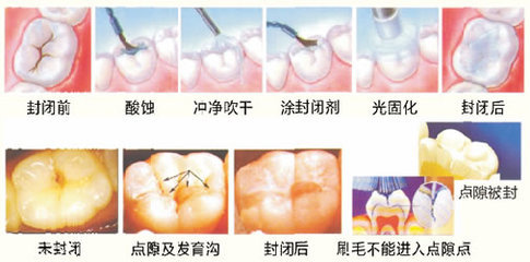 窩溝封閉多少錢