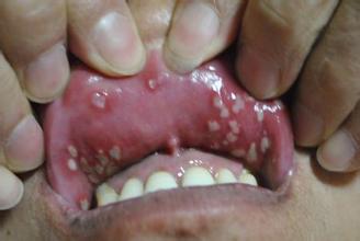 復(fù)發(fā)性口腔潰瘍怎么治