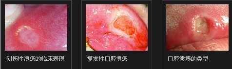 什么是口腔潰瘍