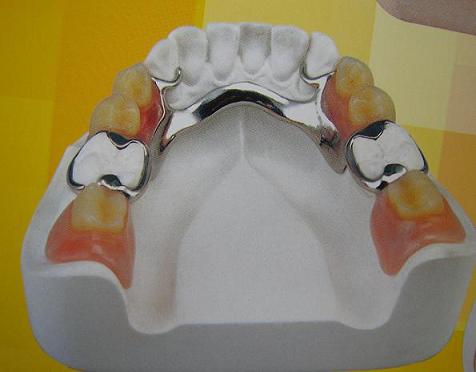 關于隱形活動義齒你知多少