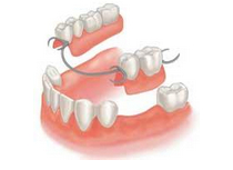 如何使用活動義齒