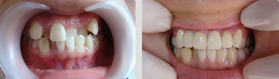 牙齒畸形的原因有哪些