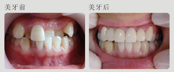 牙齒畸形的矯正方法有哪些