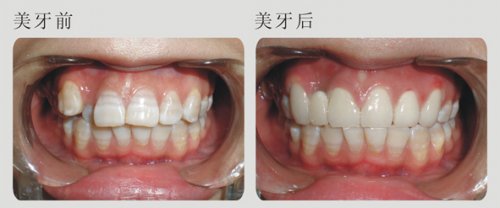 哪些畸形牙需要矯正