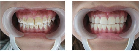 氟斑牙有什么危害