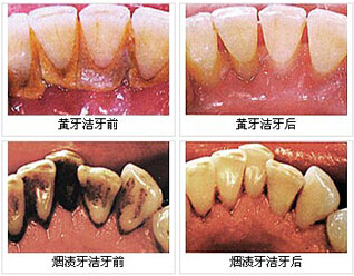 潔牙后有哪些注意事項