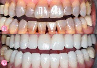 四環(huán)素牙美白需要多少錢