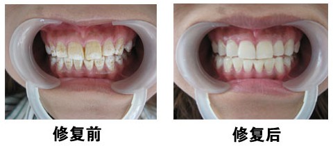 四環(huán)素牙怎么辦